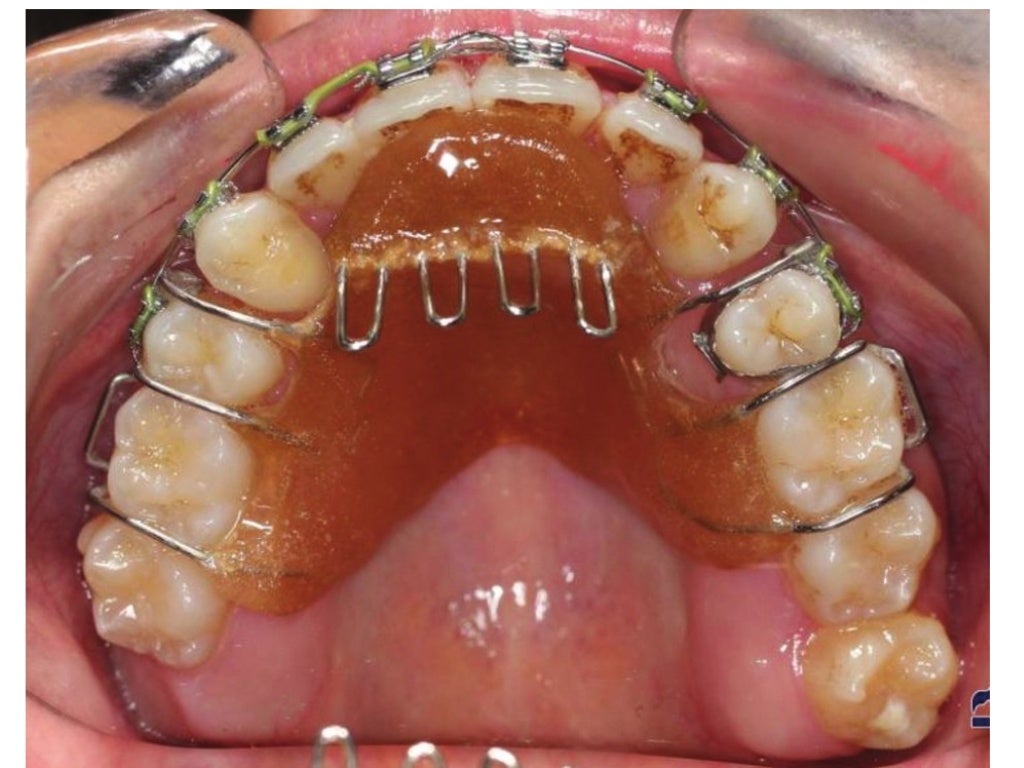 Tongue crib