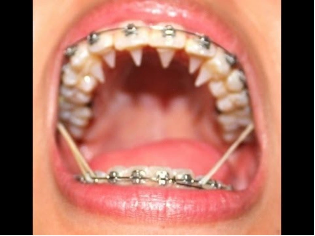 Tongue crib