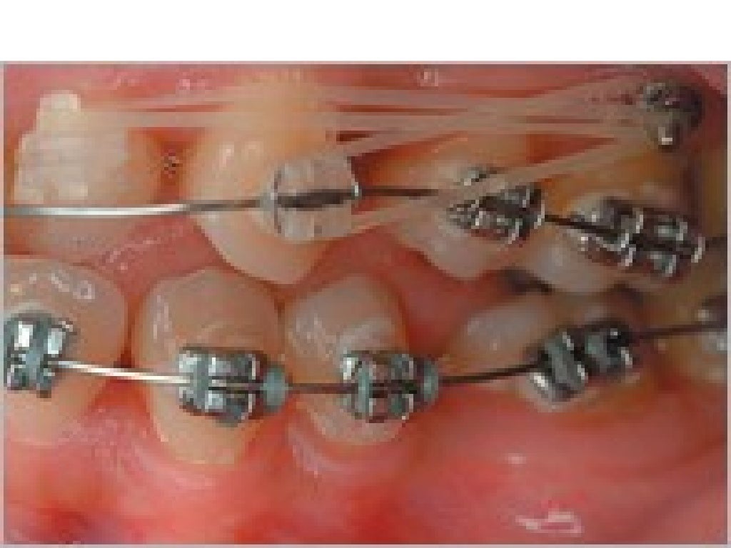 Tongue crib