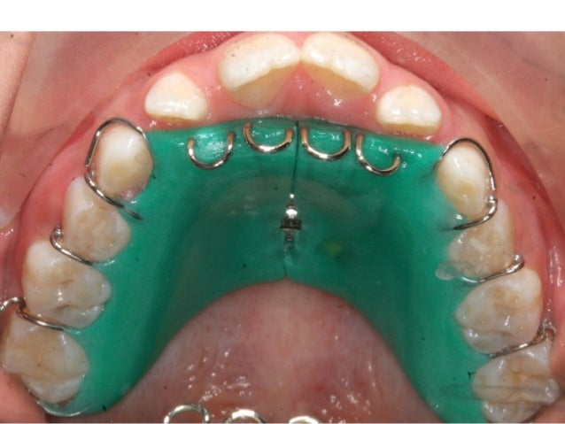 Tongue Crib
