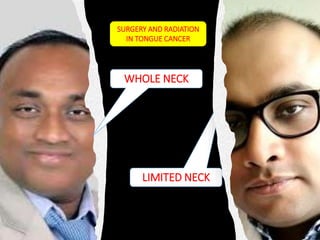 LIMITED NECK
SURGERY AND RADIATION
IN TONGUE CANCER
WHOLE NECK
 