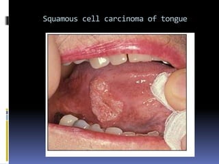 Squamous cell carcinoma of tongue
 