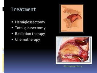Treatment
 Hemiglossectomy
 Total glossectomy
 Radiation therapy
 Chemotherapy
Hemiglossectomy
 