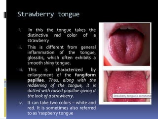 Strawberry tongue
i. In this the tongue takes the
distinctive red color of a
strawberry
ii. This is different from general
inflammation of the tongue,
glossitis, which often exhibits a
smooth shiny tongue.
iii. This is characterized by
enlargement of the fungiform
papillae. Thus, along with the
reddening of the tongue, it is
dotted with raised papillae giving it
the look of a strawberry.
iv. It can take two colors – white and
red. It is sometimes also referred
to as ‘raspberry tongue
 