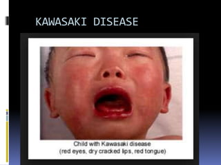 KAWASAKI DISEASE
 