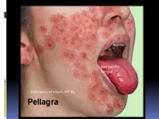 Red painful
tongue
Deficiency of niacin,VIT B3
 