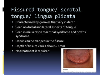 Fissured tongue/ scrotal
tongue/ lingua plicata
 Characterized by grooves that vary in depth
 Seen on dorsal and lateral aspects of tongue
 Seen in melkersson rosenthal syndrome and downs
syndrome
 Debris can be trapped in the fissure
 Depth of fissure varies about – 6mm
 No treatment is required
 