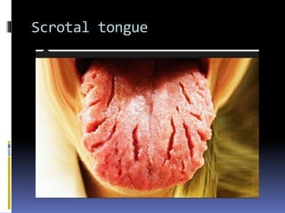 Scrotal tongue
 