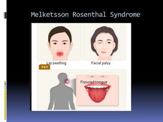 Melketsson Rosenthal Syndrome
Lip swelling Facial palsy
Fissured tongue
 