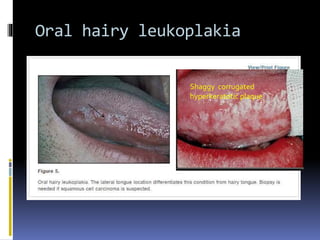 Oral hairy leukoplakia
Shaggy corrugated
hyperkeratotic plaque
 