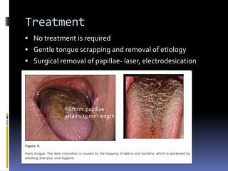 Treatment
 No treatment is required
 Gentle tongue scrapping and removal of etiology
 Surgical removal of papillae- laser, electrodesication
Filiform papillae
attains 15 mm length
 