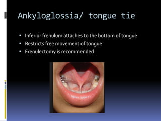 Ankyloglossia/ tongue tie
 Inferior frenulum attaches to the bottom of tongue
 Restricts free movement of tongue
 Frenulectomy is recommended
 