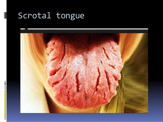 Tongue disorders