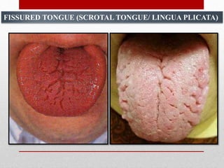 Tongue Disorders PPTX tongue-disorders-pptx
