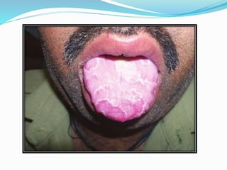 Thrush:
 Acute pseudomembranous candidiasis
 Often appears as pearly white , pinhead size flecks scattered over
the dors...