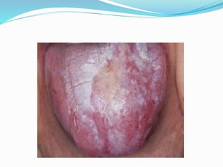  The most effective treatment to get rid of tongue ulcer
is to increase your body's immunity power by taking B-
complex t...