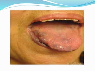 Diseases of Tongue