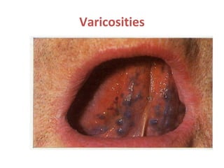Varicosities
 