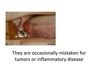 They are occasionally mistaken for
tumors or inflammatory disease
 