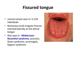 Fissured tongue
• normal variant seen in 5-11%
individuals
• Numerous small irregular fissures
oriented laterally on the dorsal
tongue
• Also seen in - Melkersson-
Rosenthal syndrome, psoriasis,
Down syndrome, acromegaly,
Sjogren syndrome
 
