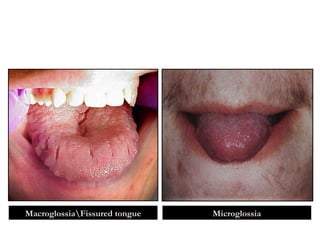 MicroglossiaMacroglossiaFissured tongue
 