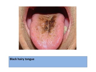 Black hairy tongue
 