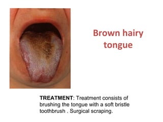 Brown hairy
tongue
TREATMENT: Treatment consists of
brushing the tongue with a soft bristle
toothbrush . Surgical scraping.
 