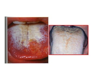 1. What is the clinical
diagnosis
2. What are the predisposing
factors?
3. What is the treatment?
 