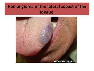 Hemangioma of the lateral aspect of the
tongue
 