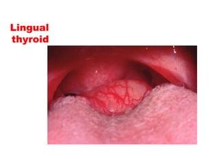 Lingual
thyroid
 