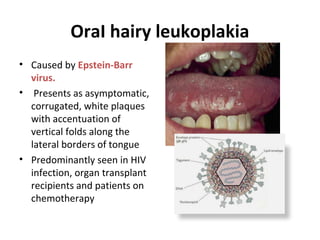 OraI hairy leukoplakia
• Caused by Epstein-Barr
virus.
• Presents as asymptomatic,
corrugated, white plaques
with accentuation of
vertical folds along the
lateral borders of tongue
• Predominantly seen in HIV
infection, organ transplant
recipients and patients on
chemotherapy
 