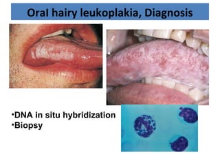 OraI hairy leukoplakia, Diagnosis
•DNA in situ hybridization
•Biopsy
 