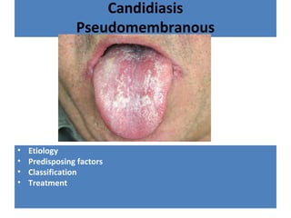 Candidiasis
Pseudomembranous
• Etiology
• Predisposing factors
• Classification
• Treatment
 