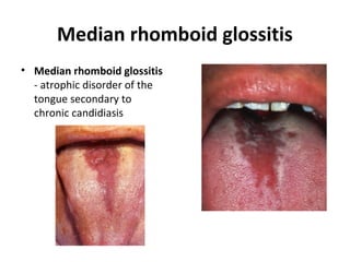 Median rhomboid glossitis
• Median rhomboid glossitis
- atrophic disorder of the
tongue secondary to
chronic candidiasis
 