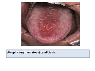 Atrophic (erythematous) candidiasis
 