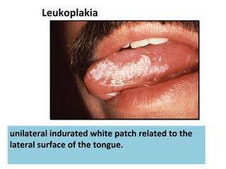 Leukoplakia
unilateral indurated white patch related to the
lateral surface of the tongue.
 