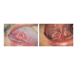 EARLY SQUAMOUS-CELL CARCINOMA
OF THE LATERAL BORDER OF THE
TONGUE
EARLY SQUAMOUS-CELL CARCINOMA
OF THE FLOOR OF THE MOUTH
 
