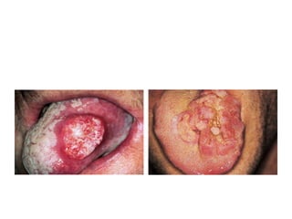 SQUAMOUS-CELL CARCINOMA PRESENTING
AS EXOPHYTIC ULCERATED TUMOR OF THE
LATERAL BORDER OF THE TONGUE.
.
LATE SQUAMOUS-CELL CARCINOMA
ON THE DORSUM OF THE TONGUE.
 