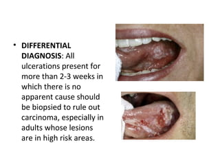 • DIFFERENTIAL
DIAGNOSIS: All
ulcerations present for
more than 2-3 weeks in
which there is no
apparent cause should
be biopsied to rule out
carcinoma, especially in
adults whose lesions
are in high risk areas.
 