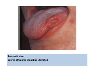 Traumatic ulcer
Source of trauma should be identified
 