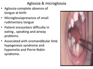 • Aglossia-complete absence of
tongue at birth
• Microglossiapresence of small
rudimentary tongue
• Patient encounters difficulty in
eating , speaking and airway
problems.
• Associated with oromandibular limb
hypogenesis syndrome and
hypomelia and Pierre Robin
syndrome.
Aglossia & microglossia
 
