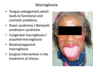 • Tongue enlargement,which
leads to functional and
cosmetic problems.
• Down syndrome / Beckwith
wiedmann syndrome
• Congenital macroglossia /
acquired macroglossia
• Relative/apparent
macroglossia
• Surgical intervention is the
treatment of choice.
Macroglossia
 