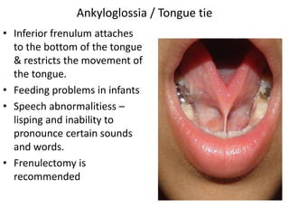 • Inferior frenulum attaches
to the bottom of the tongue
& restricts the movement of
the tongue.
• Feeding problems in infants
• Speech abnormalitiess –
lisping and inability to
pronounce certain sounds
and words.
• Frenulectomy is
recommended
Ankyloglossia / Tongue tie
 