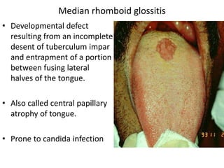 • Developmental defect
resulting from an incomplete
desent of tuberculum impar
and entrapment of a portion
between fusing lateral
halves of the tongue.
• Also called central papillary
atrophy of tongue.
• Prone to candida infection
Median rhomboid glossitis
 