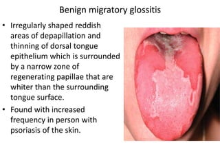 • Irregularly shaped reddish
areas of depapillation and
thinning of dorsal tongue
epithelium which is surrounded
by a narrow zone of
regenerating papillae that are
whiter than the surrounding
tongue surface.
• Found with increased
frequency in person with
psoriasis of the skin.
Benign migratory glossitis
 
