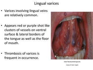 • Varices involving lingual veins
are relatively common.
• Appears red or purple shot like
clusters of vessels on ventral
surface & lateral borders of
the tongue as well as the floor
of mouth.
• Thrombosis of varices is
frequent in occurrence.
Lingual varices
 