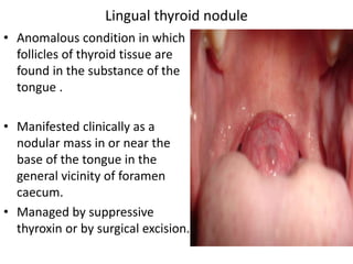• Anomalous condition in which
follicles of thyroid tissue are
found in the substance of the
tongue .
• Manifested clinically as a
nodular mass in or near the
base of the tongue in the
general vicinity of foramen
caecum.
• Managed by suppressive
thyroxin or by surgical excision.
Lingual thyroid nodule
 