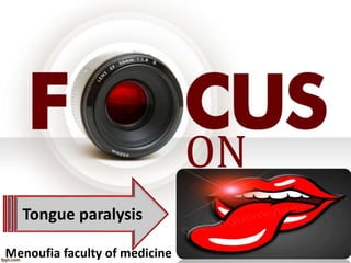 Tongue paralysis
ON
Menoufia faculty of medicine
 