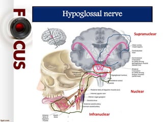 Hypoglossal nerve
Supranuclear
Infranuclear
Nuclear
 