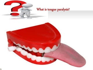 What is tongue paralysis?
 